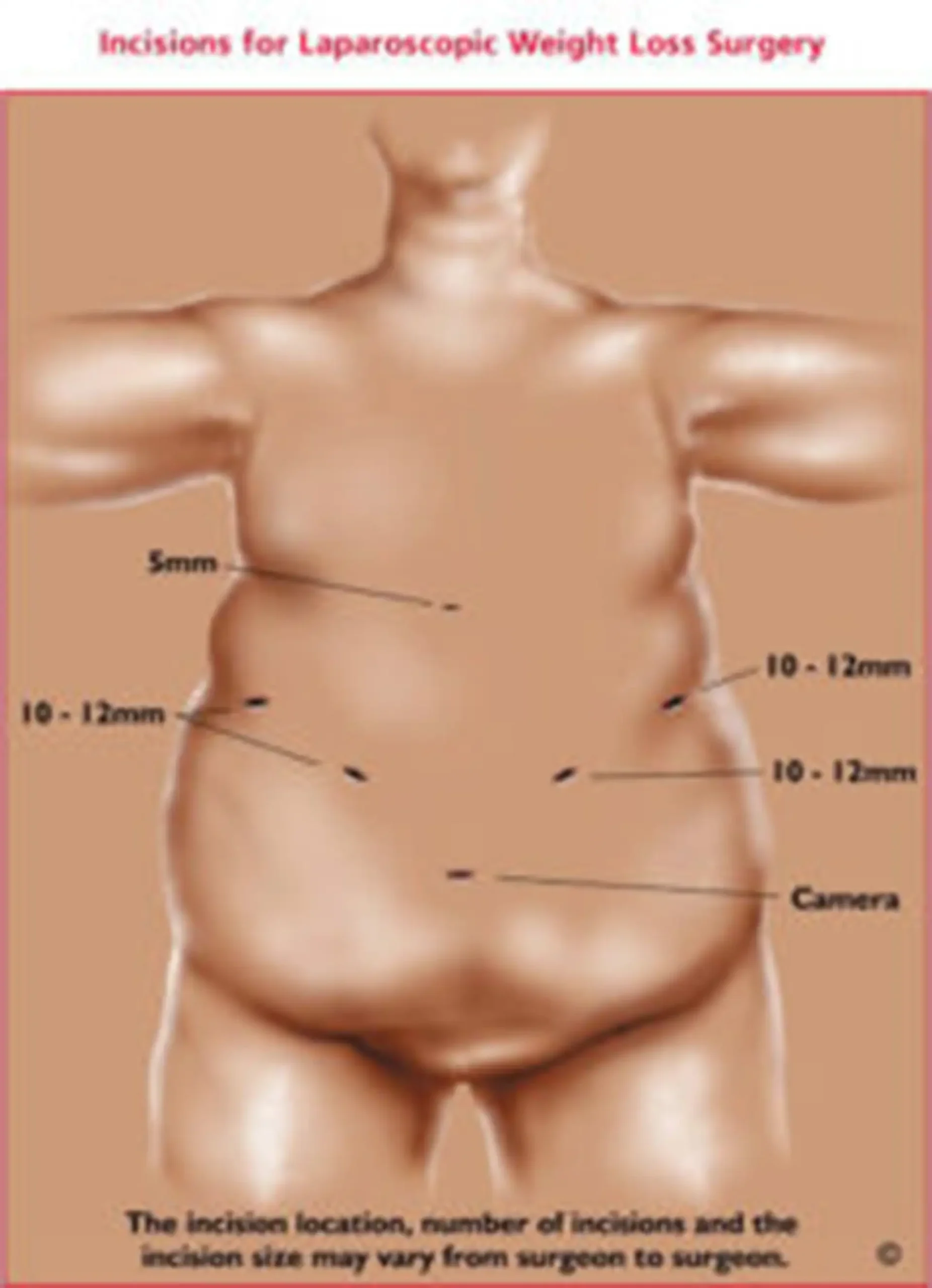 image showing areas affected by laparoscopic gastric bypass surgery