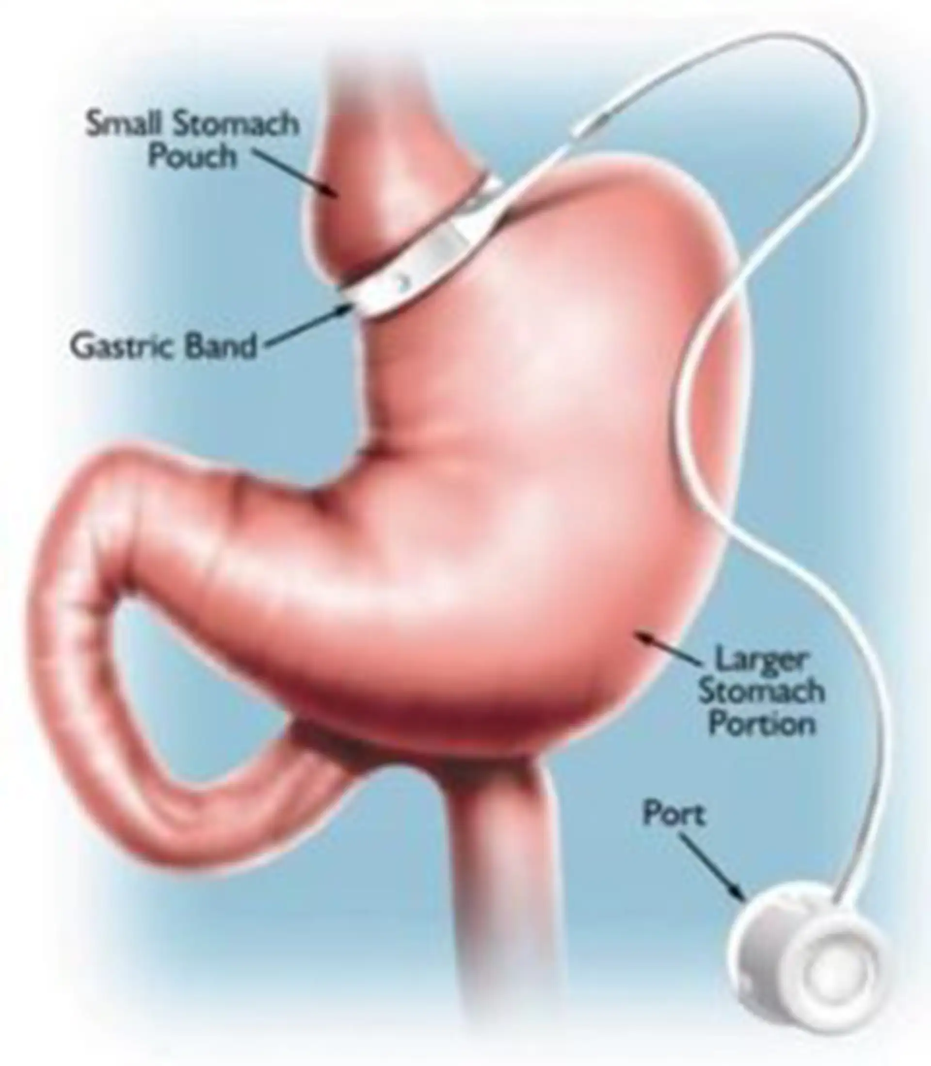  diagram of laparoscopic adjustable band procedure