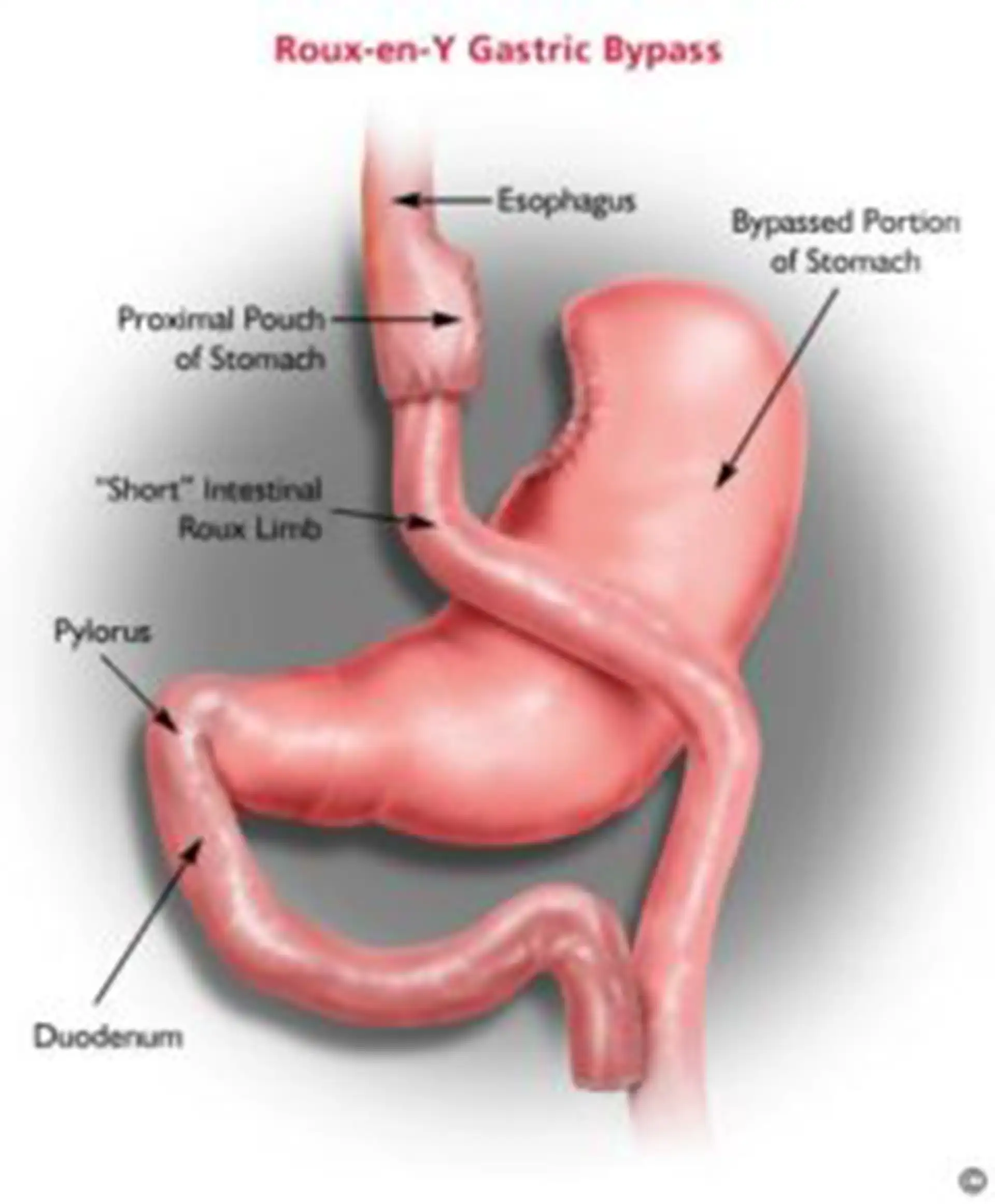 diagram of stomach for laparoscopic gastric bypass procedure