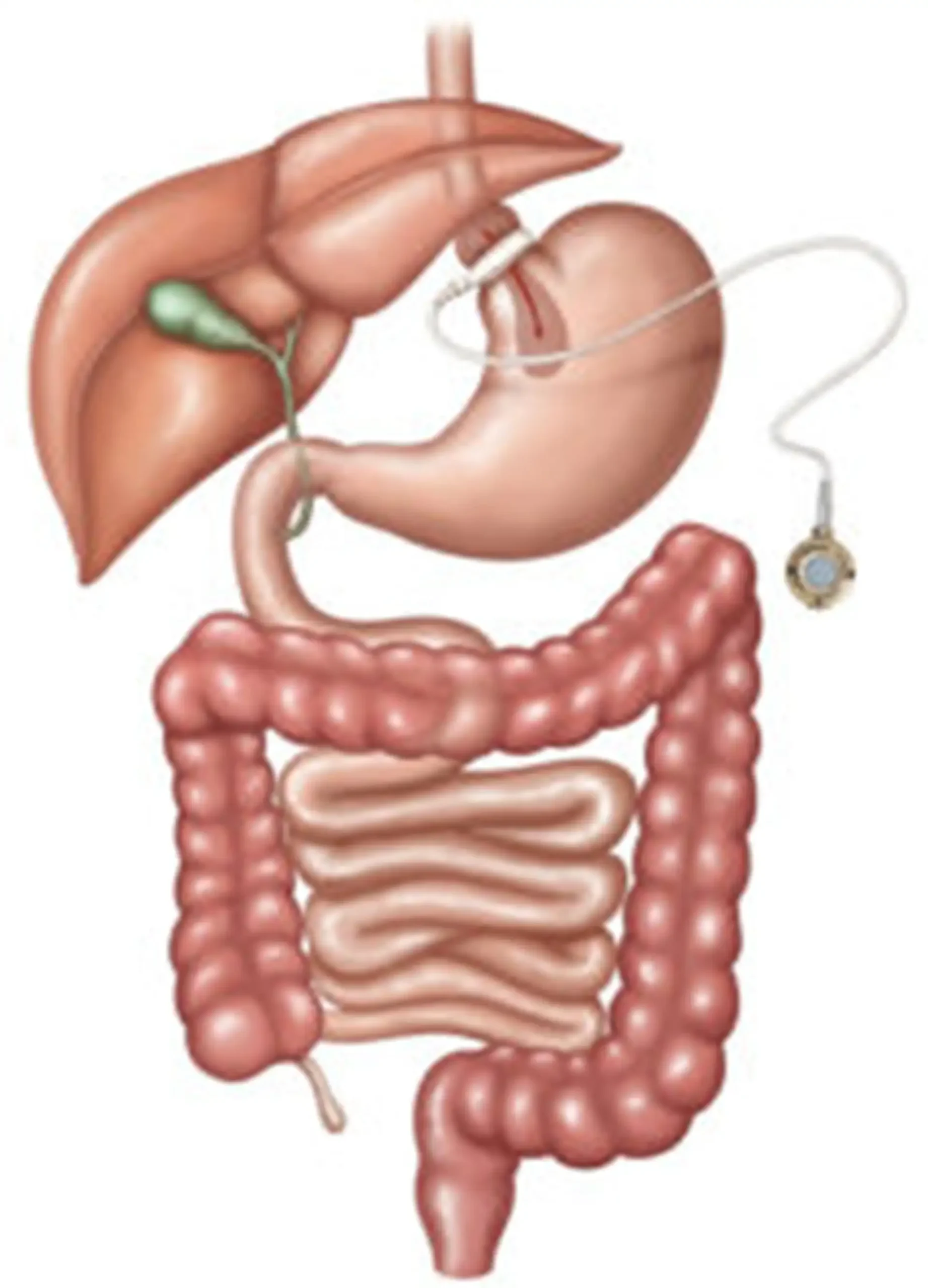 drawing of a laparoscopic adjustable gastric band procedure and it effects on other organs 