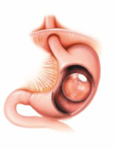 diagram of orbera gastric balloon procedure