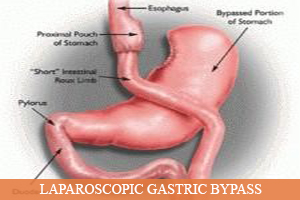 Laparoscopic Gastric Bypass in Decatur, AL