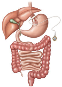 gastric band explanation