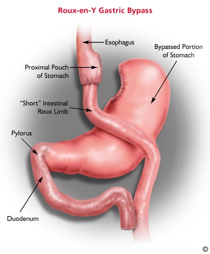 Gastric Bypass