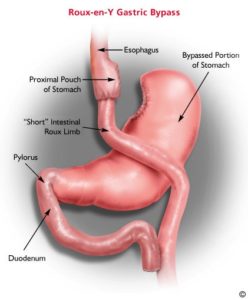 gastric bypass diagram