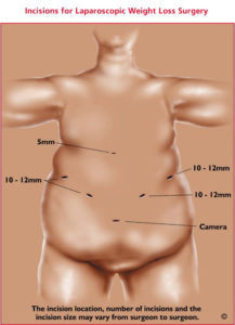 gastric bypass incision diagram