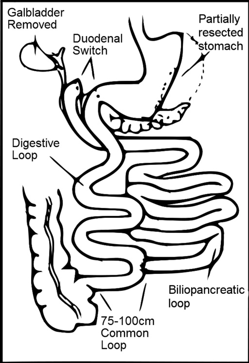 512px-Sleeve_gastrectomy_duodenal_switch