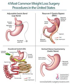 Affordable Weight Loss Surgery Options